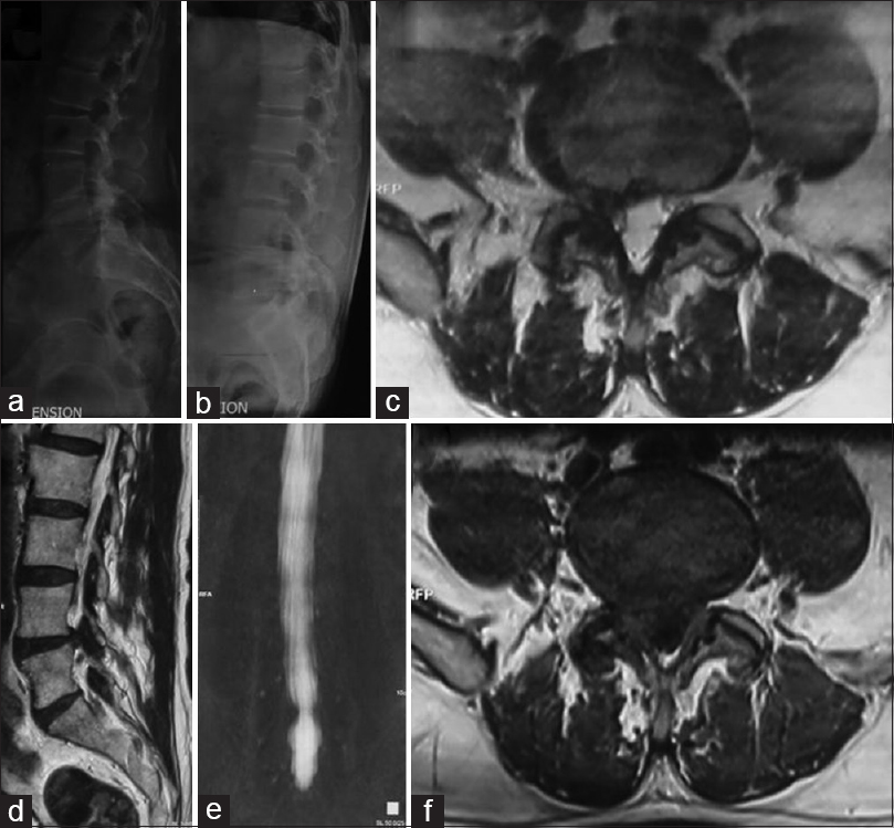 A 68-year-old male with unilateral right-sided radiculopathy and back pain for 14 months. (a and b) Radiograph lateral flexion and extension views showing instability Grade 1 listhesis. (c-f) Magnetic resonance imaging T2-axial, T2-parasagittal, coronal magnetic resonance myelogram, and T1 axial sequences showing a lateral recess stenosis right side with facetal arthritis/sagittal facet with a small disc prolapse